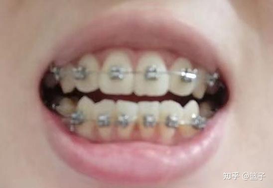 成人矫正牙齿神器视频,告别传统束缚，重拾自信笑容