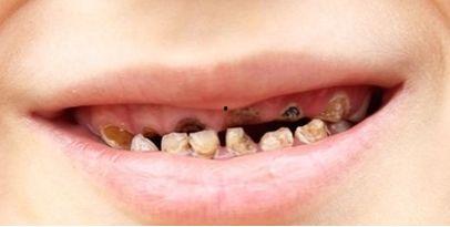 成人吃糖牙齿烂掉的视频